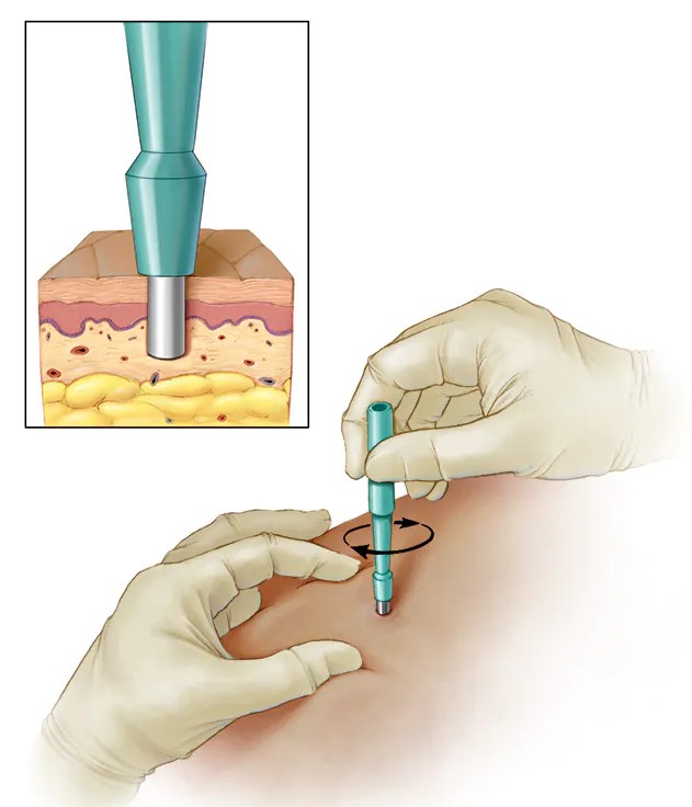 biopsja-wycinek.jpg